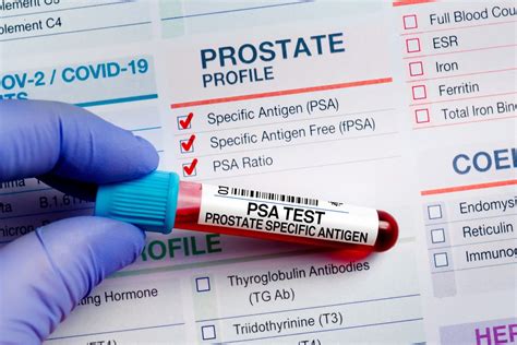 What to Avoid Before a PSA (Prostate Specific Antigen) Test.